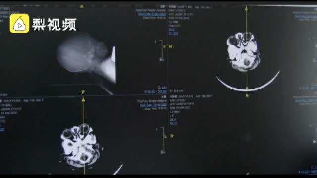 哺乳妈妈不吃青菜致婴儿脑出血,医生:缺乏维生素k影响凝血功能